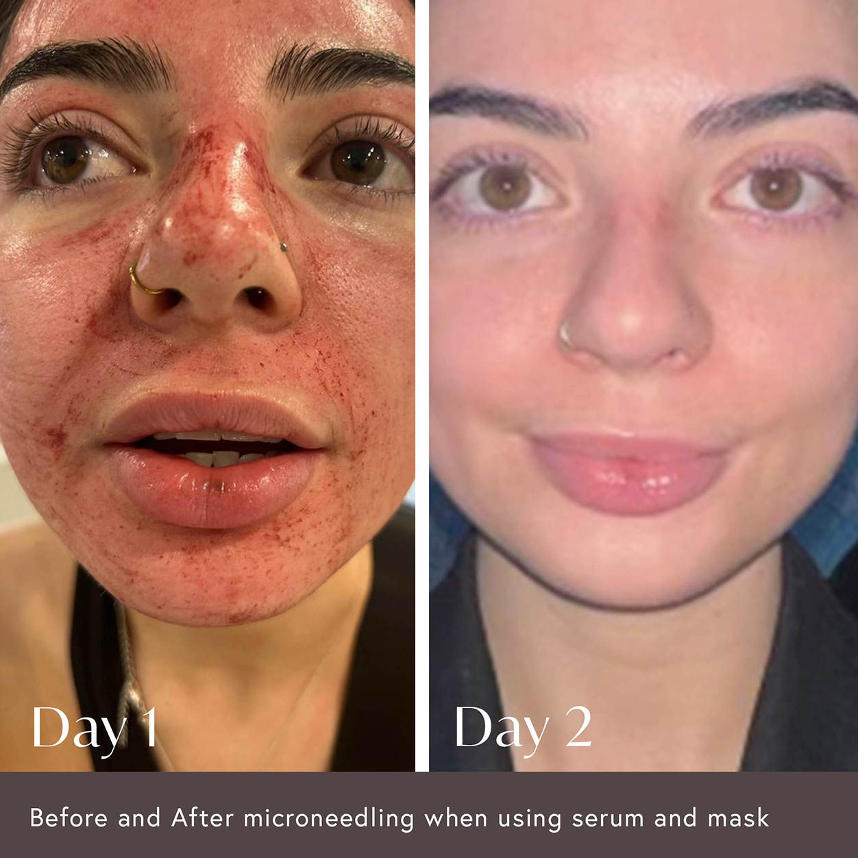Hidden Agenda Pre and Post Injection Care Serum – Anti-Aging & Skin Recovery Treatment for Wrinkles & Fine Lines | Perfect for Botox, Fillers, and Cosmetic Procedures