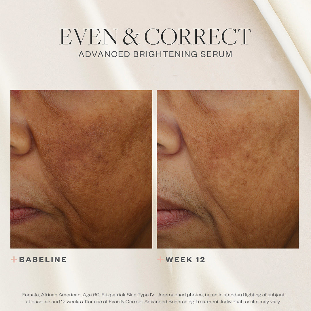 Even & Correct Advanced Brightening Treatment - Skin Brightening Serum for Dark Spots & Uneven Tone - Perfect for Daily Skincare Routine & Nighttime Use