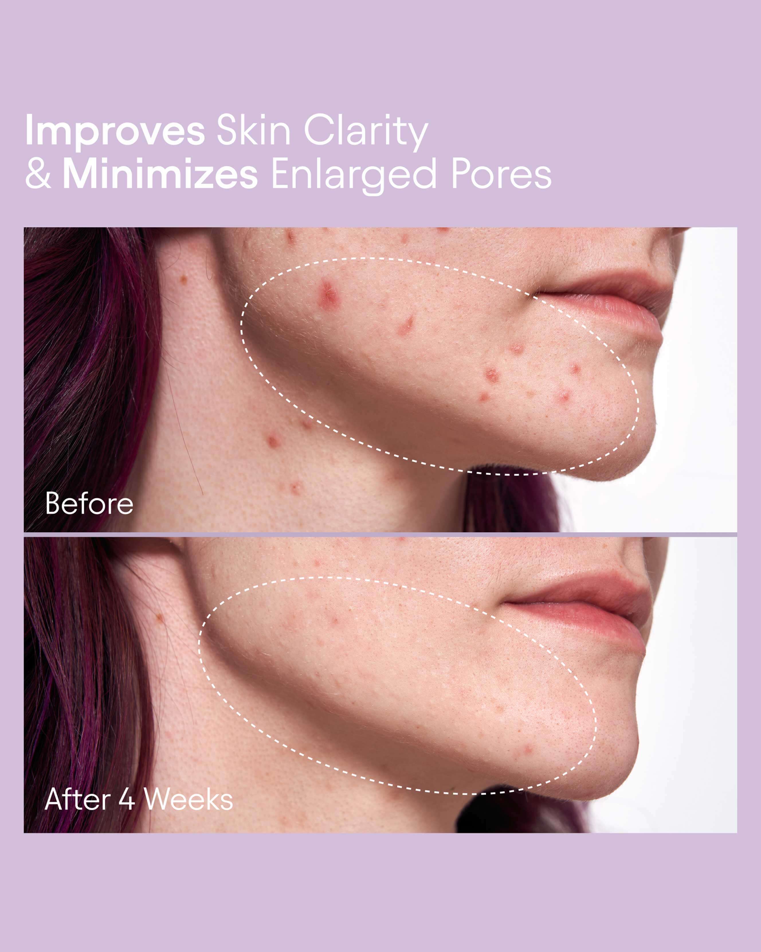 2% BHA + Borage Oil Pore Perfecting Liquid - Exfoliating Face Treatment for Blackheads & Acne | Daily Skincare for Oily & Combination Skin