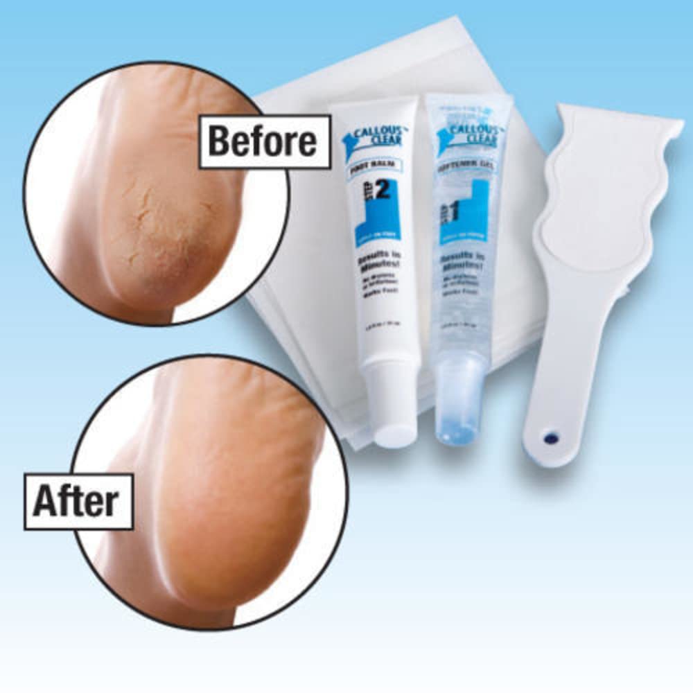 Callous Clear Foot Treatment Kit - Deluxe Foot Cream & Heel Balm with Scraper & File for Smooth Soft Feet | Cracked Heel Repair, Dry Skin Care, Pedicure at Home