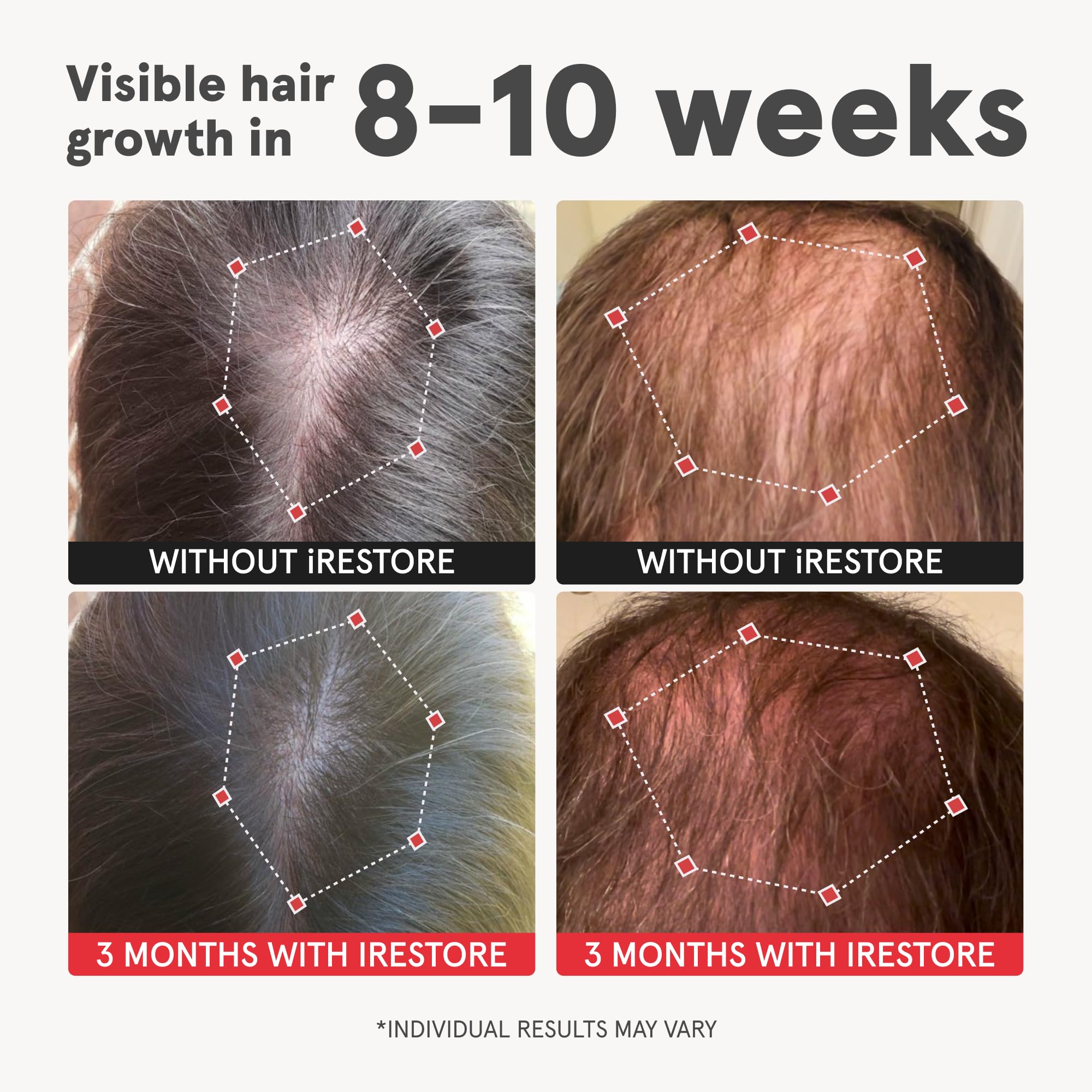 iRESTORE Advanced Hair Growth Supplement for Women - Hair Vitamins for Faster Hair Regrowth, Thicker & Healthier Hair | Best for Hair Loss & Thinning | 3 Pack (1 Month Supply Each) | Perfect for Postpartum, Stress-Related & Age-Related Hair Thinning | Promotes Stronger, Shinier Hair Naturally