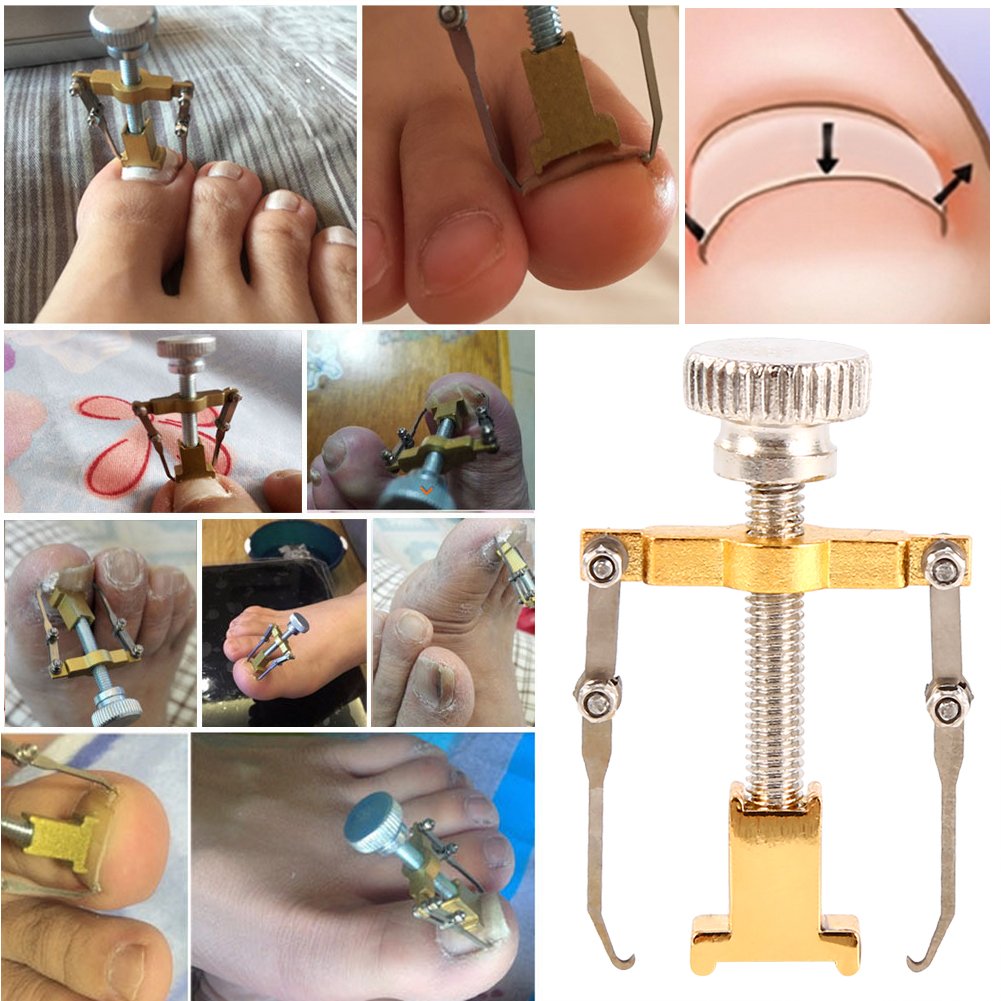 Professional Ingrown Toenail Corrector Kit - Pain Relief & Treatment for Ingrown Nails, Paronychia - Pedicure Tools for Toe Care & Nail Correction - Perfect for Home Use & Salon Treatments