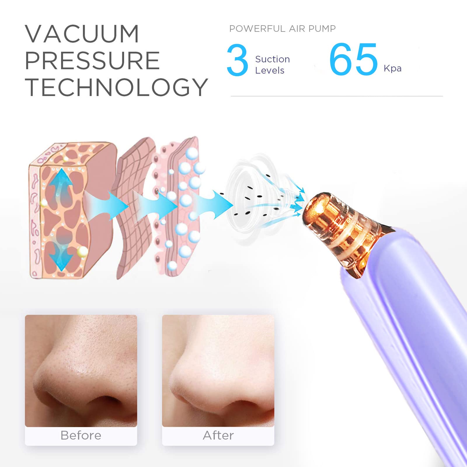 Electric Blackhead Remover Pore Vacuum Cleaner - USB Powered Facial Pore Cleaner with 5 Attachments - Deep Cleansing Blackhead Suction Tool Kit (Purple) for Acne Prone Skin & Blackhead Removal - Perfect for Daily Skincare Routine & Spa Treatments