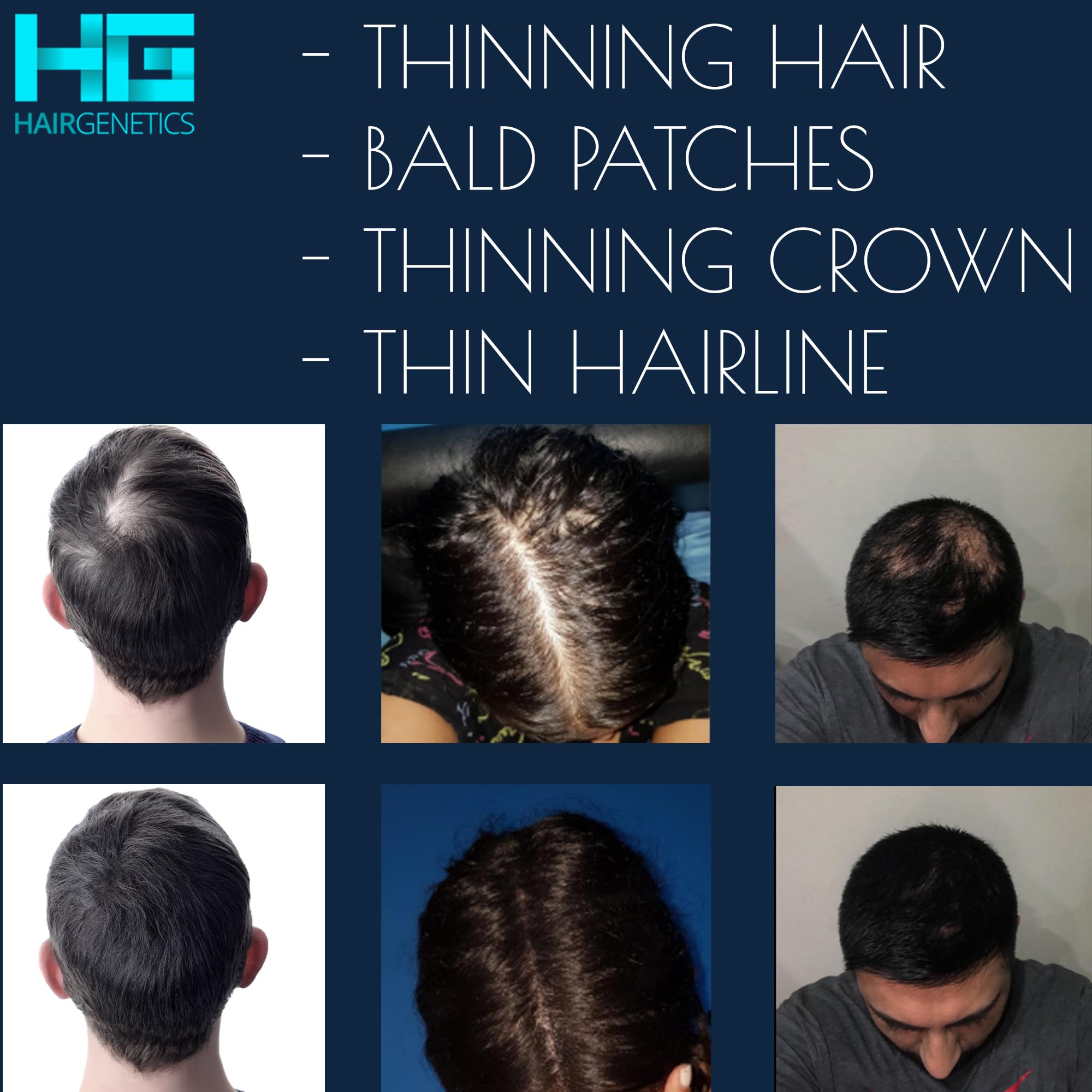 Medium Brown Hair Fibers for Hair Loss - 22g Hair Thickening Fibers for Men & Women - Covers Thin Hair & Bald Spots - Natural-Looking Hair Fibers for Thicker Fuller Hair - Perfect for Daily Use, Work, and Special Occasions