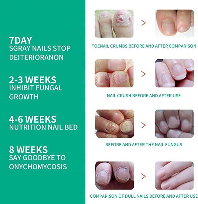 Kerassentials Toenail Fungal Treatment Oil - Extra Strong Foot & Nail Repair Kit for Fungus Relief | Athlete's Foot Care, Nail Restoration for Healthy Toes