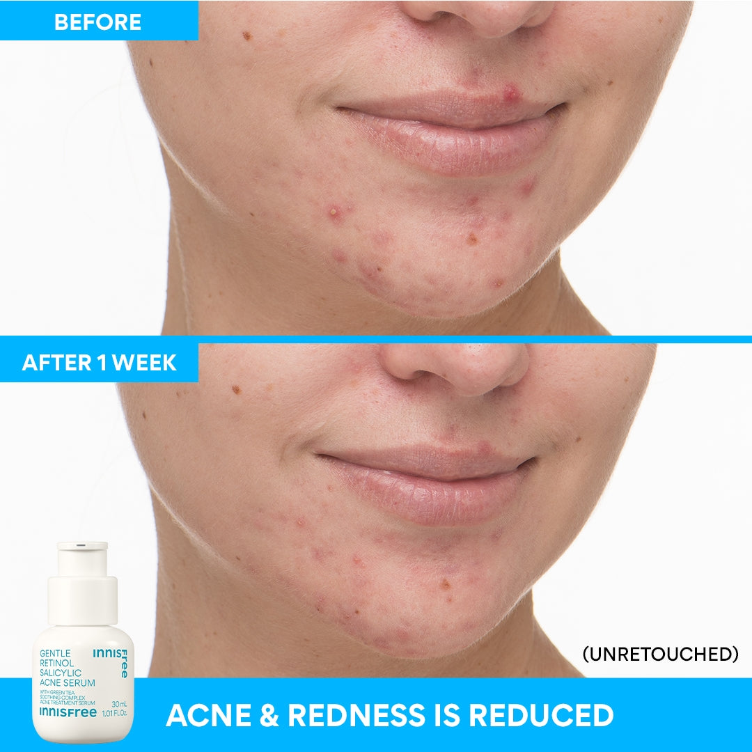 Gentle Retinol & Salicylic Acid Acne Serum for Clear Skin - Fights Breakouts & Reduces Blemishes - Perfect for Oily & Acne-Prone Skin