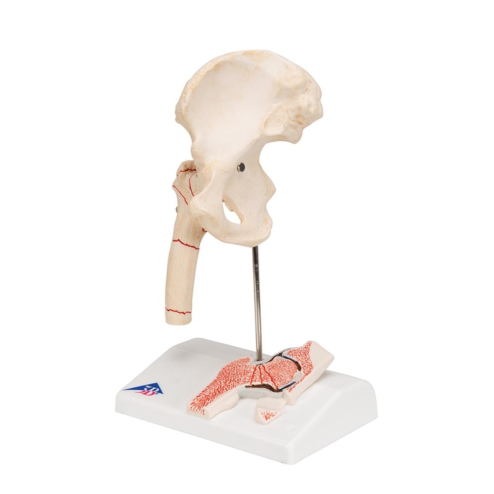 Femoral Fracture & Hip Osteoarthritis Anatomical Model - Medical Training, Student Education, and Clinical Demonstration Tool