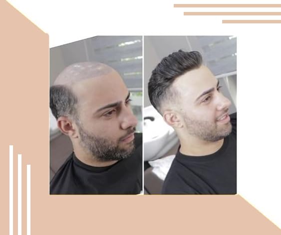Kabello Hair Loss Solution - 6 Inch Human Hair Toupee with Mono Base (9x7, Dark Brown) | Hair Patch & Wigs for Men | Includes 4 Wig Clips & Free Small Red Tap | Perfect for Thinning Hair, Bald Spots & Daily Styling