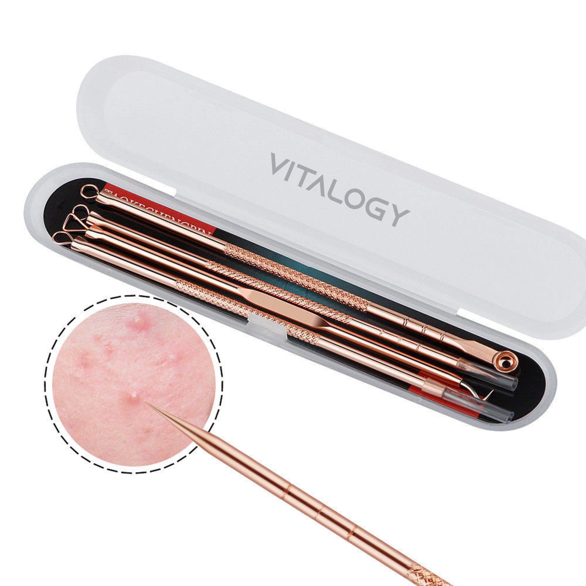 Vitalogy 4-in-1 Blackhead Remover Kit - Professional Acne & Pimple Extractor Tool for Nose & Face - Includes Blackhead & Whitehead Removal Tools, Tweezers & Travel Case (Rose Gold) - Perfect for Travel & At-Home Skincare Routine