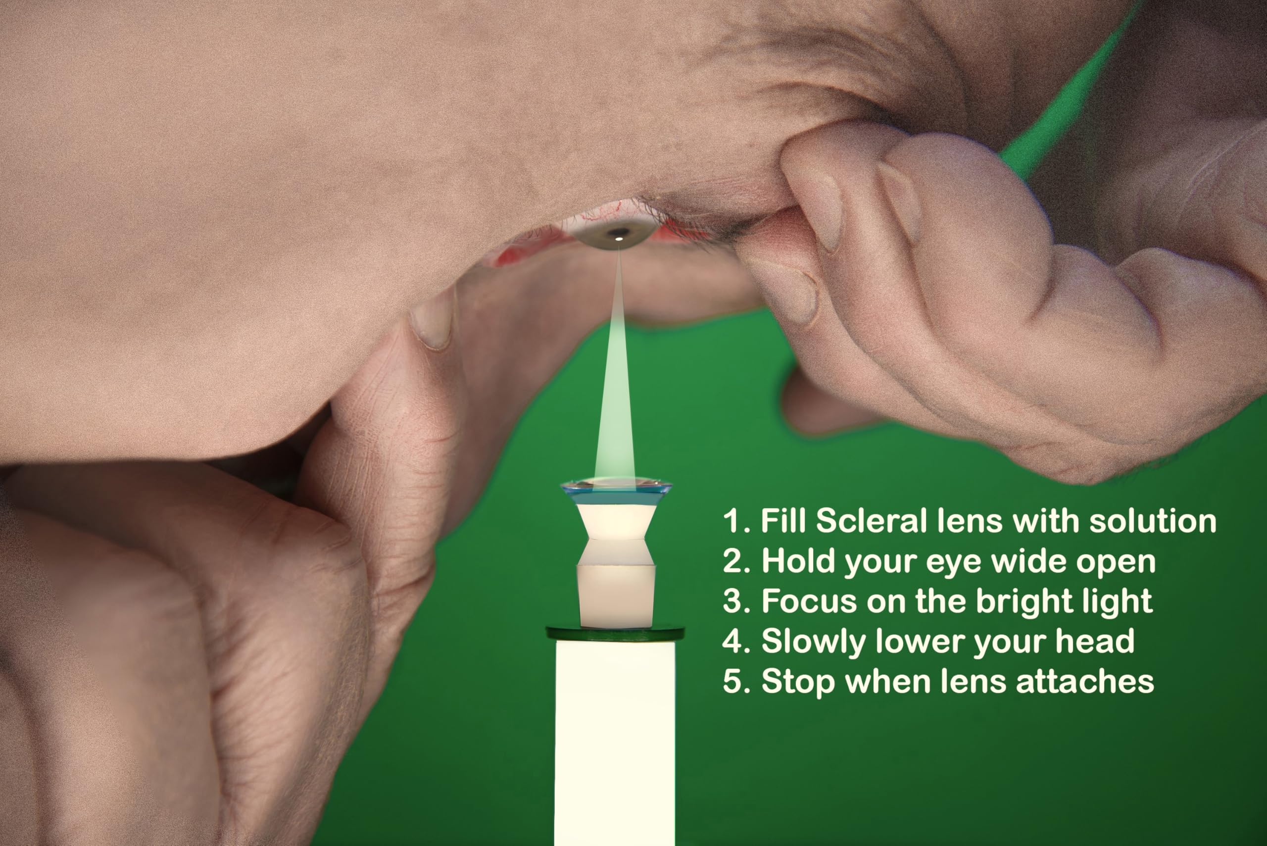 Premium Stack-SL1 Scleral Lens Inserter System – Quick Alignment, Bubble-Free Application, Durable & Watertight Design with Focused Light – Ideal for Eye Care Professionals & Contact Lens Specialists