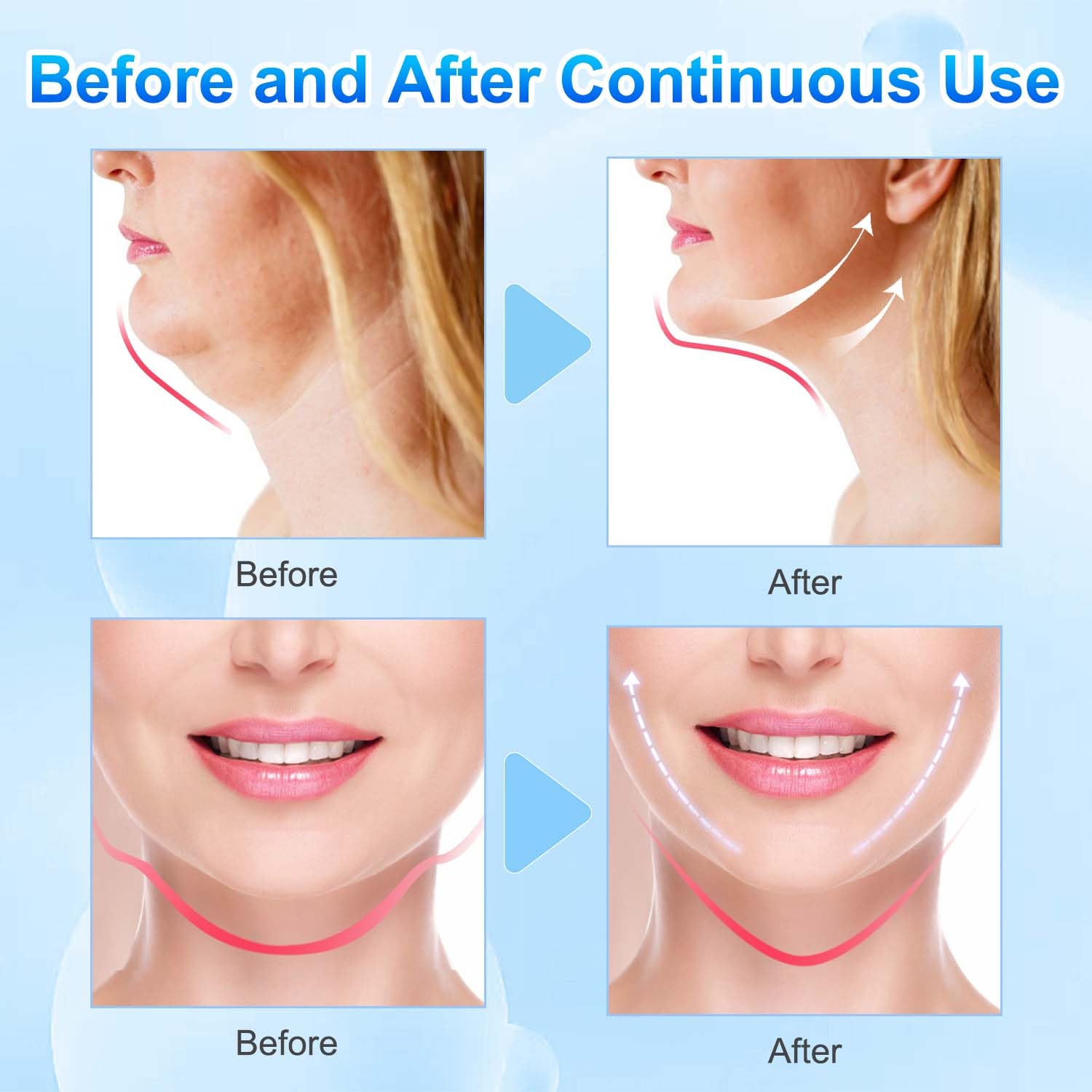 2024 Bloskin Double Chin Mask Reusable - V Line Lifting Face Mask for All Skin Types, Firming & Tightening (5 Pack) | At-Home Facial Treatment & Self-Care Routine