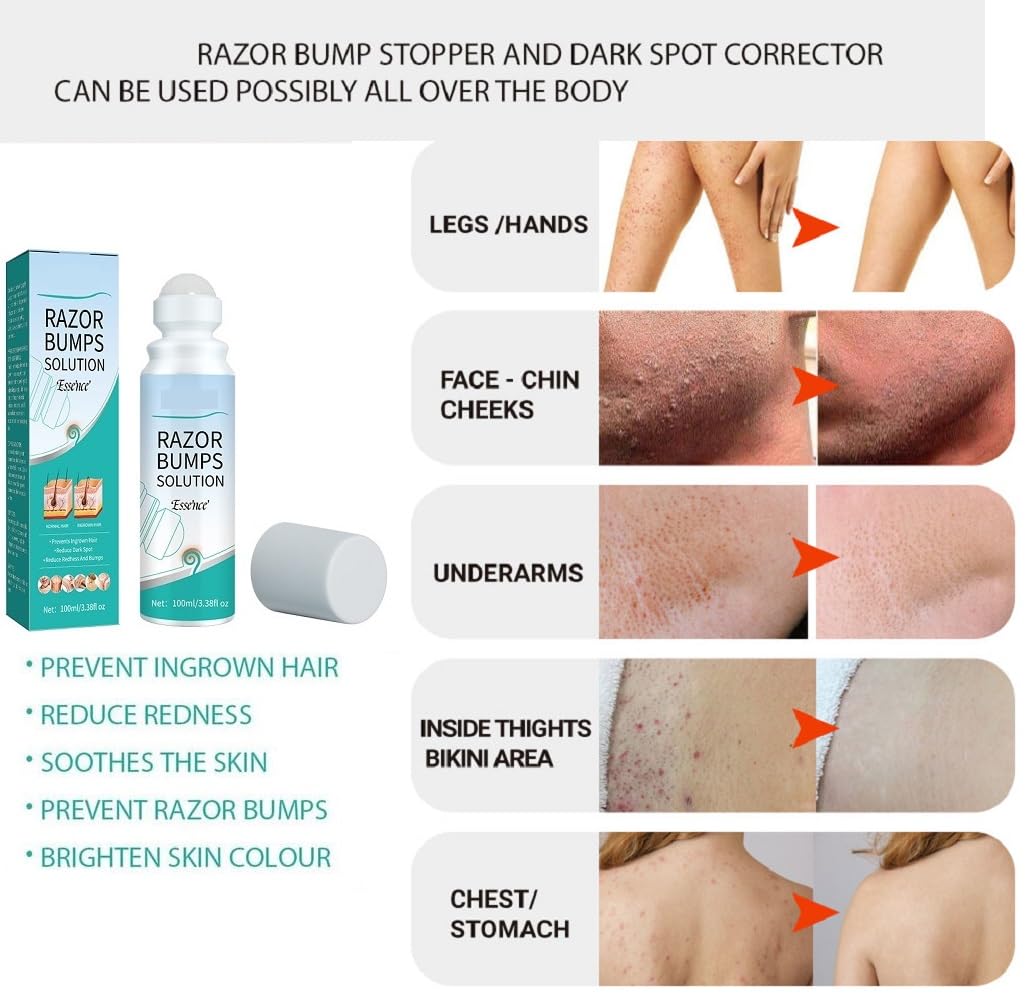 Best Razor Bumps Treatment Solution for Men & Women | Ingrown Hair Prevention | Redness & Itch Relief | Moisturizing Repair Essence | Post-Shave Care for Smooth Skin