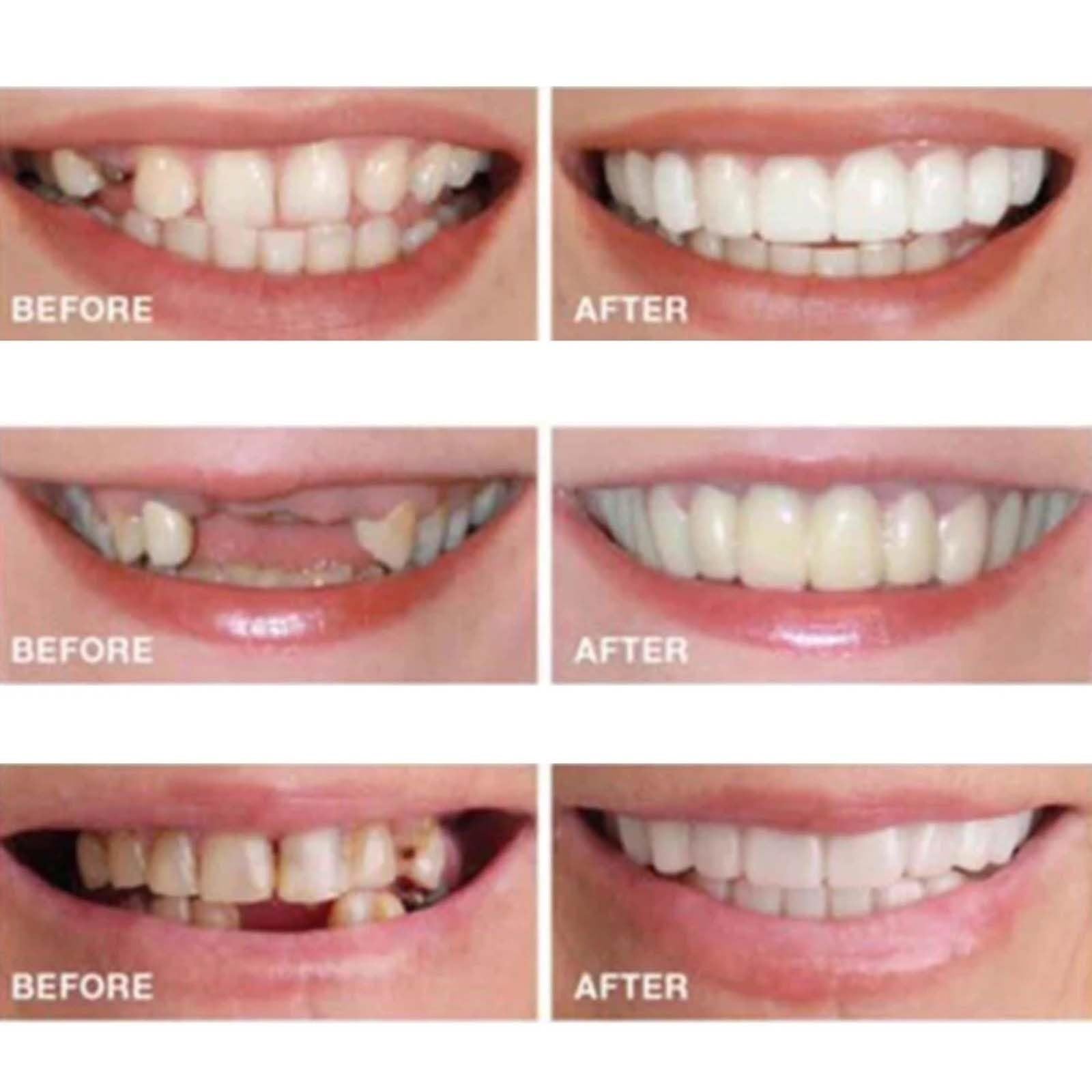 2 Pairs Adjustable Temporary Dentures - Natural & Comfortable Fit for Confident Smiling - Perfect for Eating, Speaking & Special Occasions