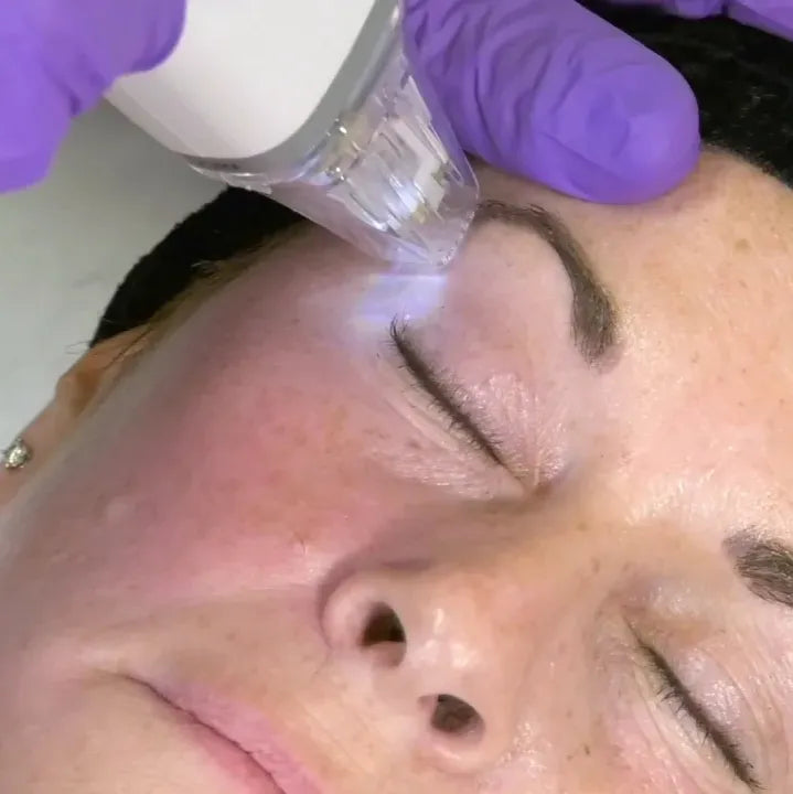 Professional RF Microneedling Mesotherapy Device for Skin Rejuvenation - Anti-Aging & Wrinkle Reduction Treatment for Face & Body - Perfect for Home Use & Salon Treatments