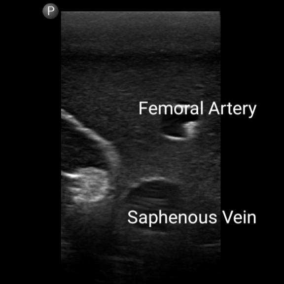 Gen II Femoral Vascular Access & Regional Anesthesia Ultrasound Training Model - Medical Simulation for Ultrasound-Guided Procedures Practice
