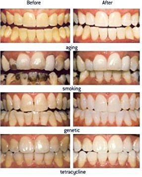 NiceWhites Teeth Whitening Kit with 3ml 44% Syringe & Gummy Tray - Professional At-Home Whitening Solution for Brighter Smile | Perfect for Special Occasions & Daily Confidence Boost