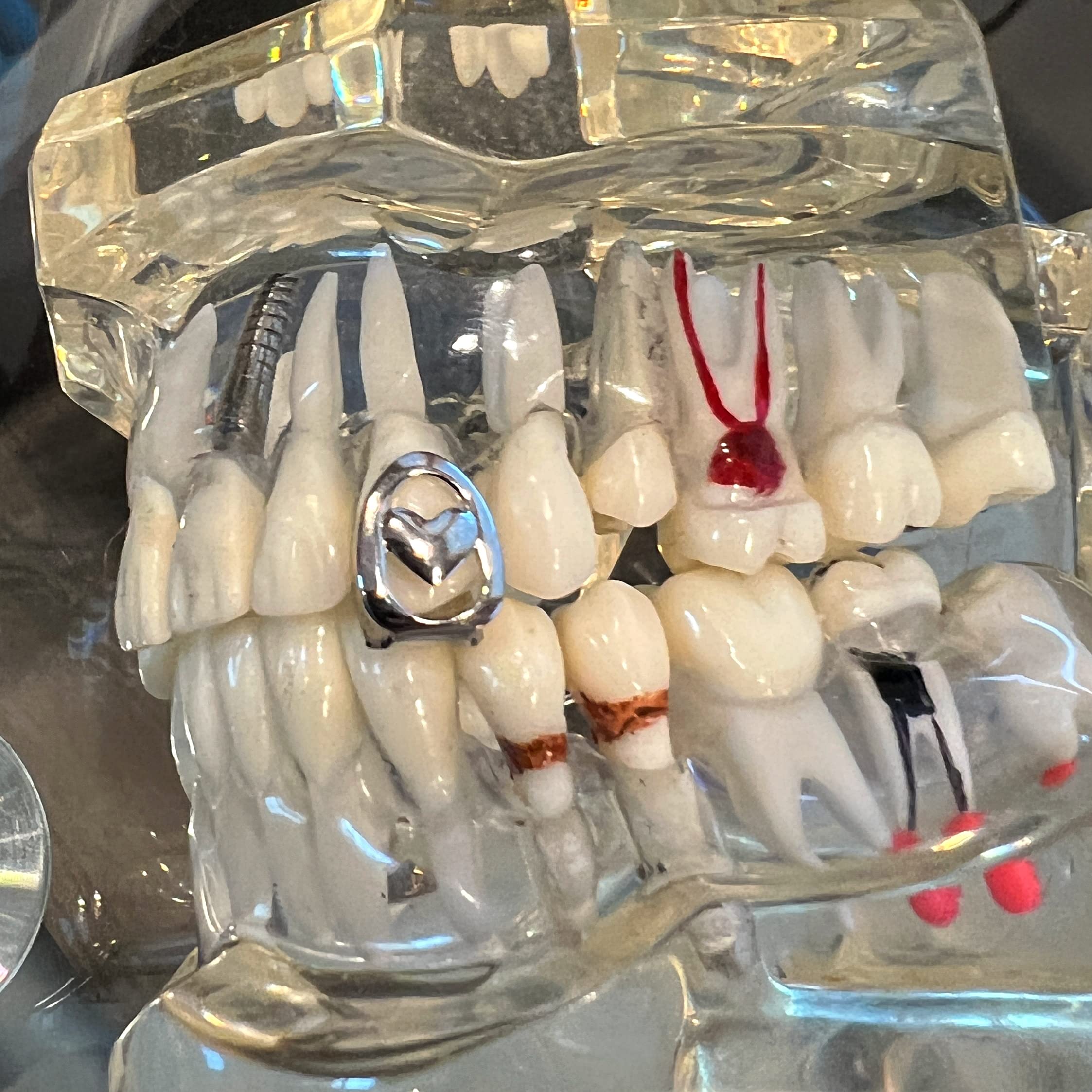 Silver Tone Open Face Heart Grillz - Single Cap Top Upper Canine Tooth Grill for Hip Hop Style with Teeth Mold | Perfect for Rappers, Performers & Jewelry Enthusiasts