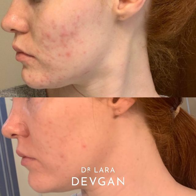 Best Minimalist Acne Treatment for Clear Skin - Clinically Proven & Dermatologist Recommended | Perfect for Daily Skincare Routine & Teenage Acne Care