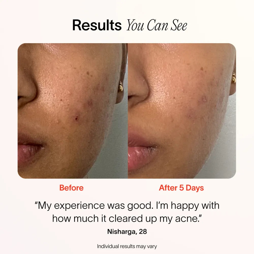 Bye Acne: Fast-Acting 3 Minute Pimple Spot Treatment for Clear Skin | Perfect for Overnight Use & On-The-Go Acne Care
