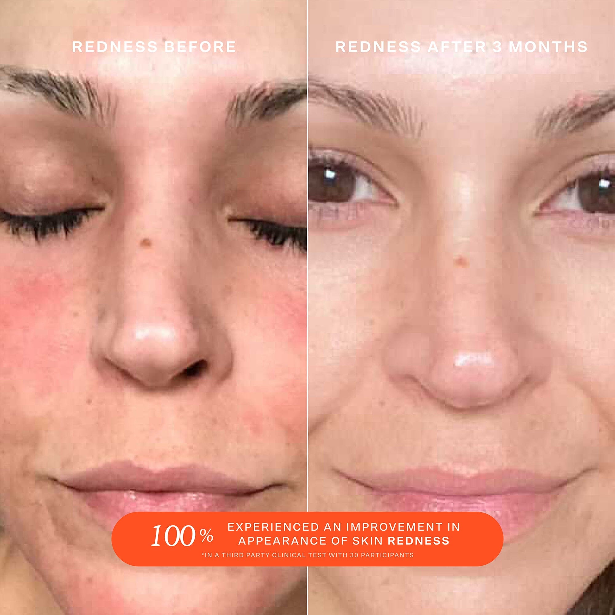 SOS Save Our Skin Daily Rescue Facial Spray with Hypochlorous Acid - Hydrating & Soothing Face Mist for Acne, Rosacea & Sensitive Skin - Perfect for Travel, Gym & Post-Workout Refresh