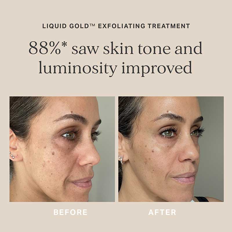 Alpha H Liquid Gold Exfoliating Treatment with 5% Glycolic Acid - Chemical Exfoliator for Glowing Skin | Perfect for Nighttime Skincare Routine & Acne-Prone Skin
