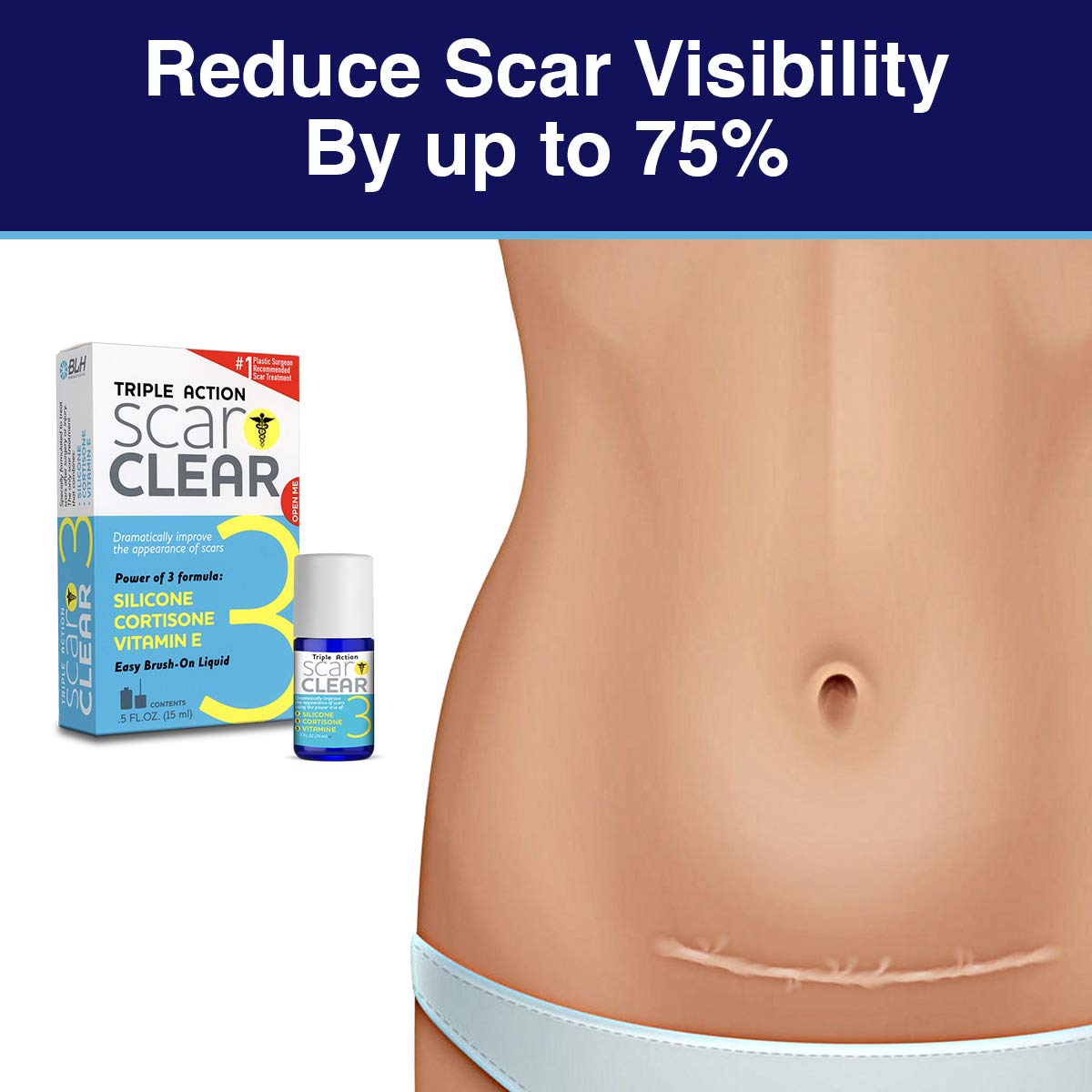 Triple Action Scar Treatment Cream - 0.5oz for Face & Body | Reduces Appearance of Scars, Stretch Marks & Acne Marks | Post-Surgery & Injury Recovery