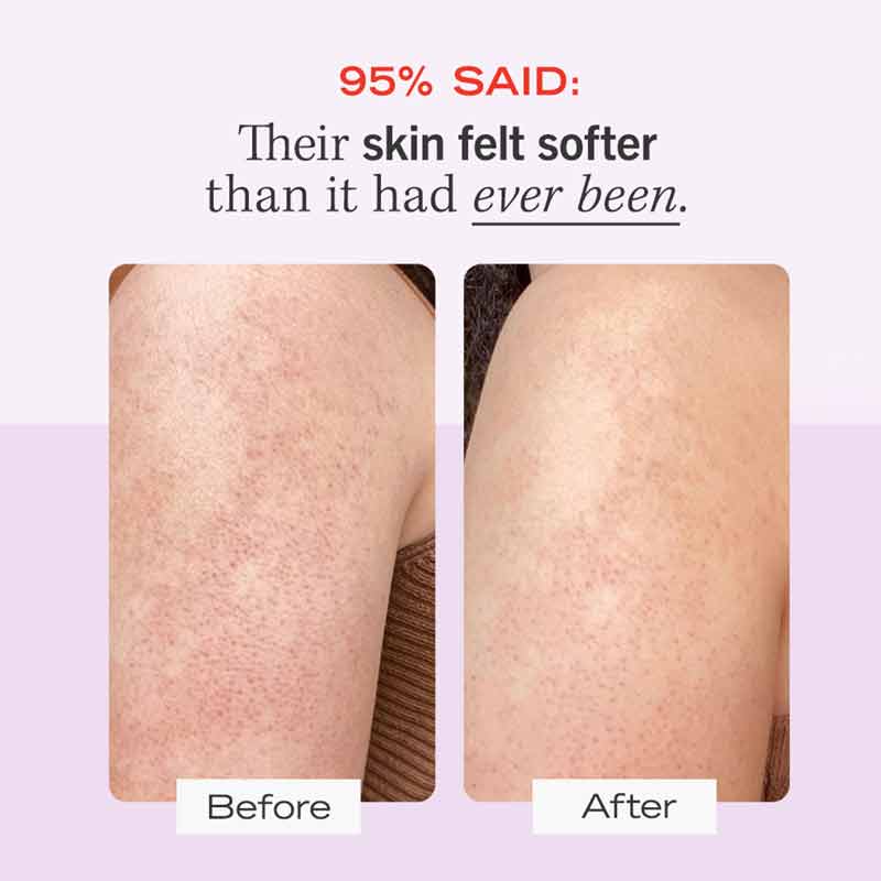 First Aid Beauty KP Bump Eraser Body Scrub with 10% AHA - Exfoliating Treatment for Keratosis Pilaris & Smooth Skin | Perfect for Dry, Bumpy Skin Care Routine