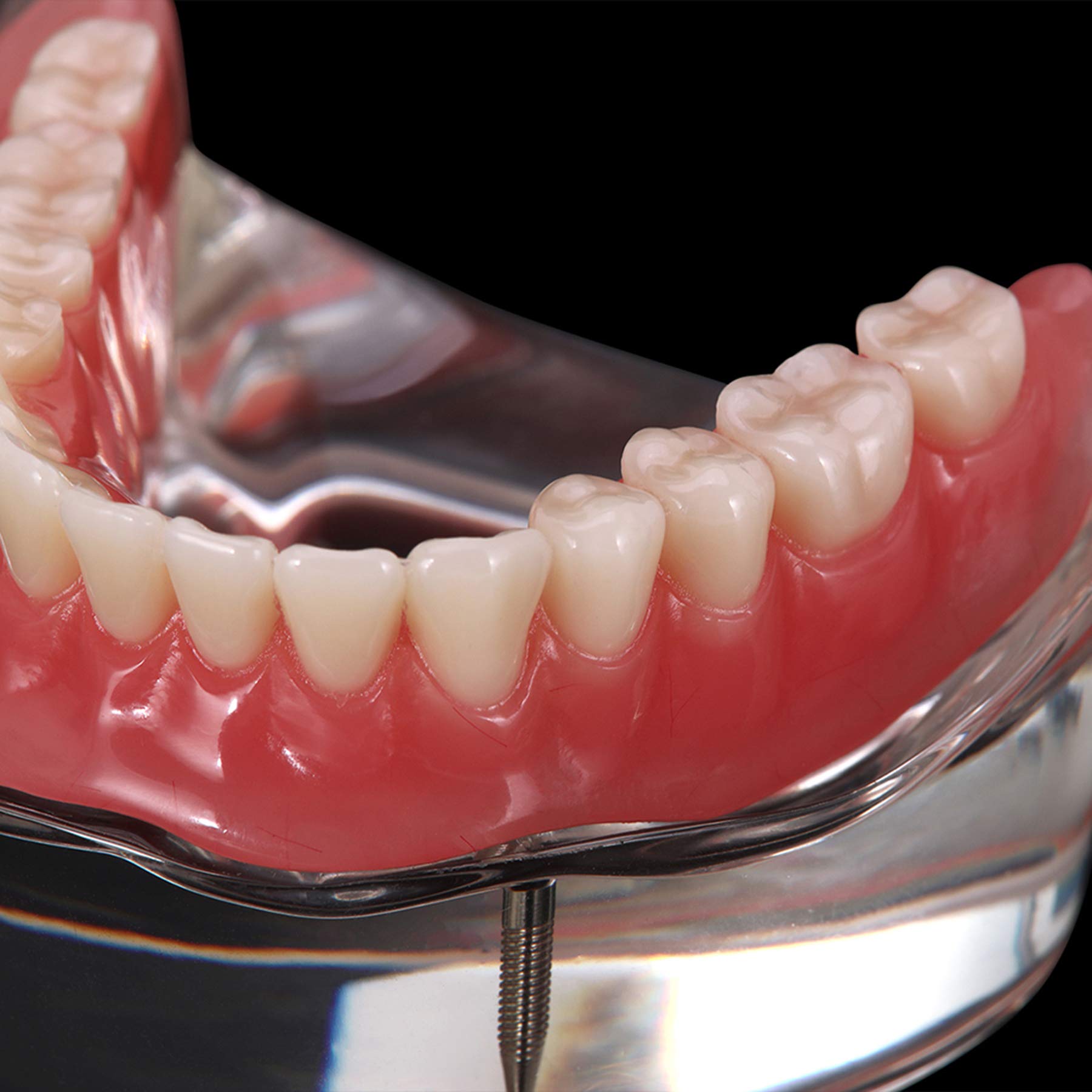Premium Dental Implant Demo Model - M6002 Overdenture Restoration Kit with 2 Implants | Ideal for Dental Education, Training & Patient Demonstration