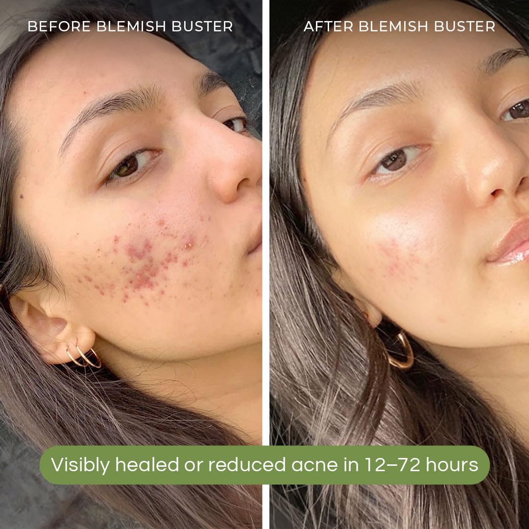SONYA DAKAR Blemish Buster - Acne Spot Treatment with Salicylic Acid & Sulfur for Clear Skin | Camphor & Probiotics (Lactobacillus/Bifidobacterium) | Tinted Clean Beauty Formula .25 oz - Perfect for Daytime Use & On-the-Go Skincare