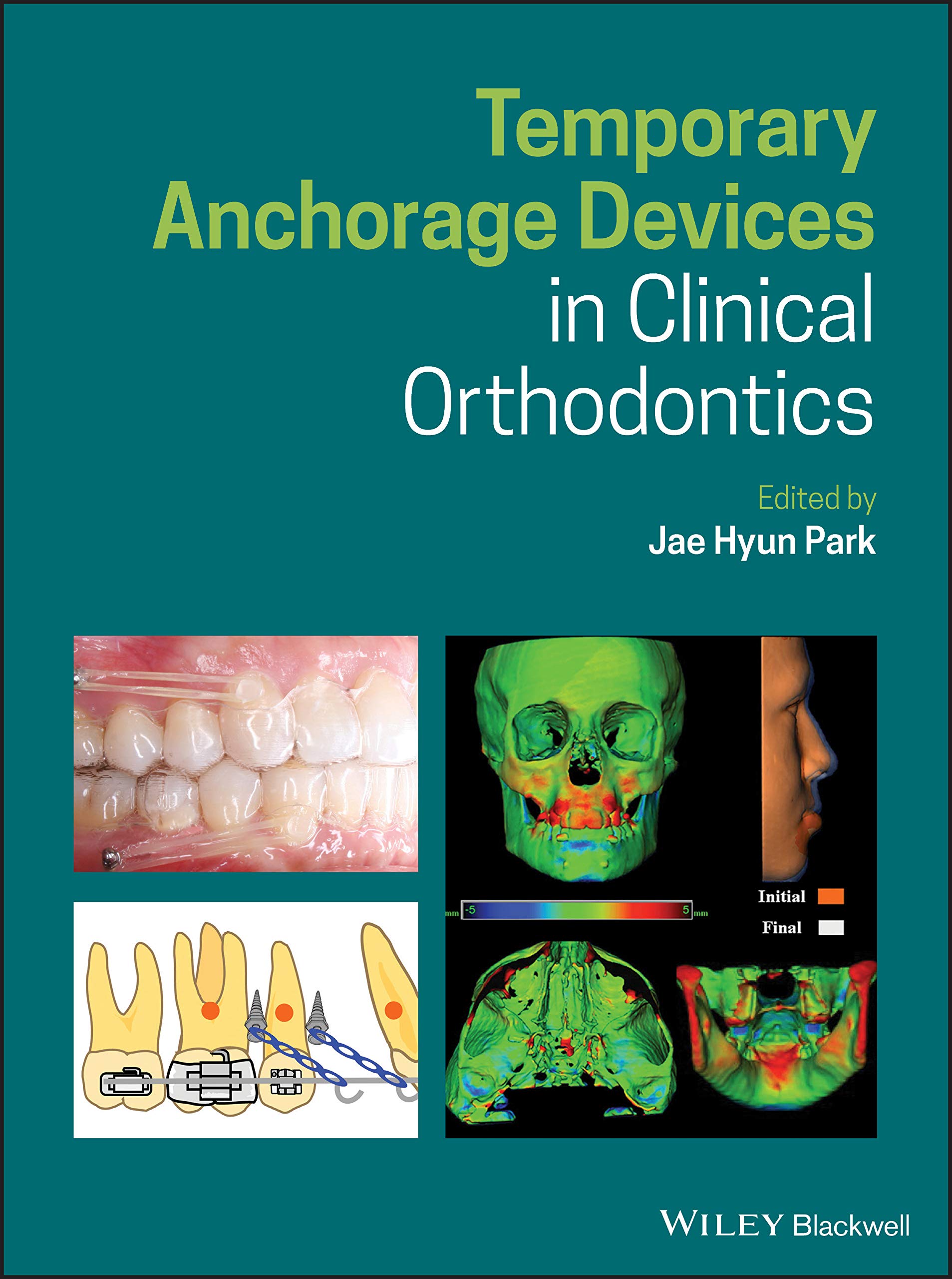 Temporary Anchorage Devices (TADs) for Orthodontic Treatment - Clinical Dental Braces Anchors for Teeth Alignment & Correction | Perfect for Orthodontists & Dental Professionals