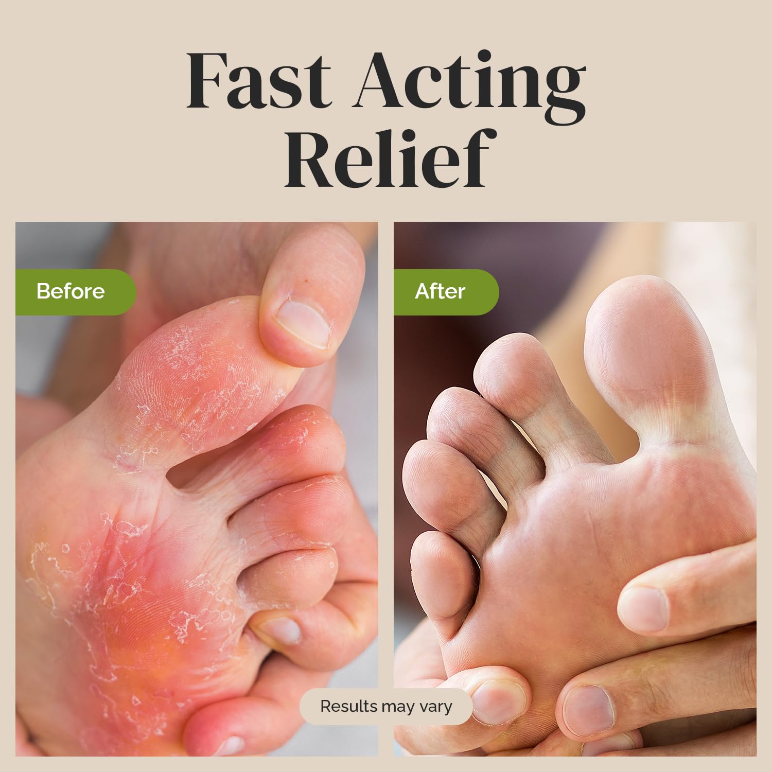 Puriya Tea Tree Oil Antifungal Cream - Extra Strength Plant-Based Treatment for Athlete's Foot, Jock Itch & Ringworm - Soothing Itchy Skin Relief for Men & Women - Ideal for Gym, Sports & Daily Foot Care