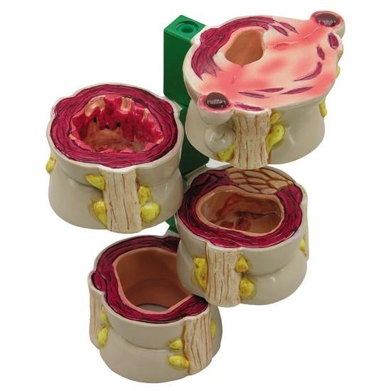 4-Piece Colon Anatomy Model with Pathologies - Ideal for Medical Students, Doctors & Healthcare Professionals