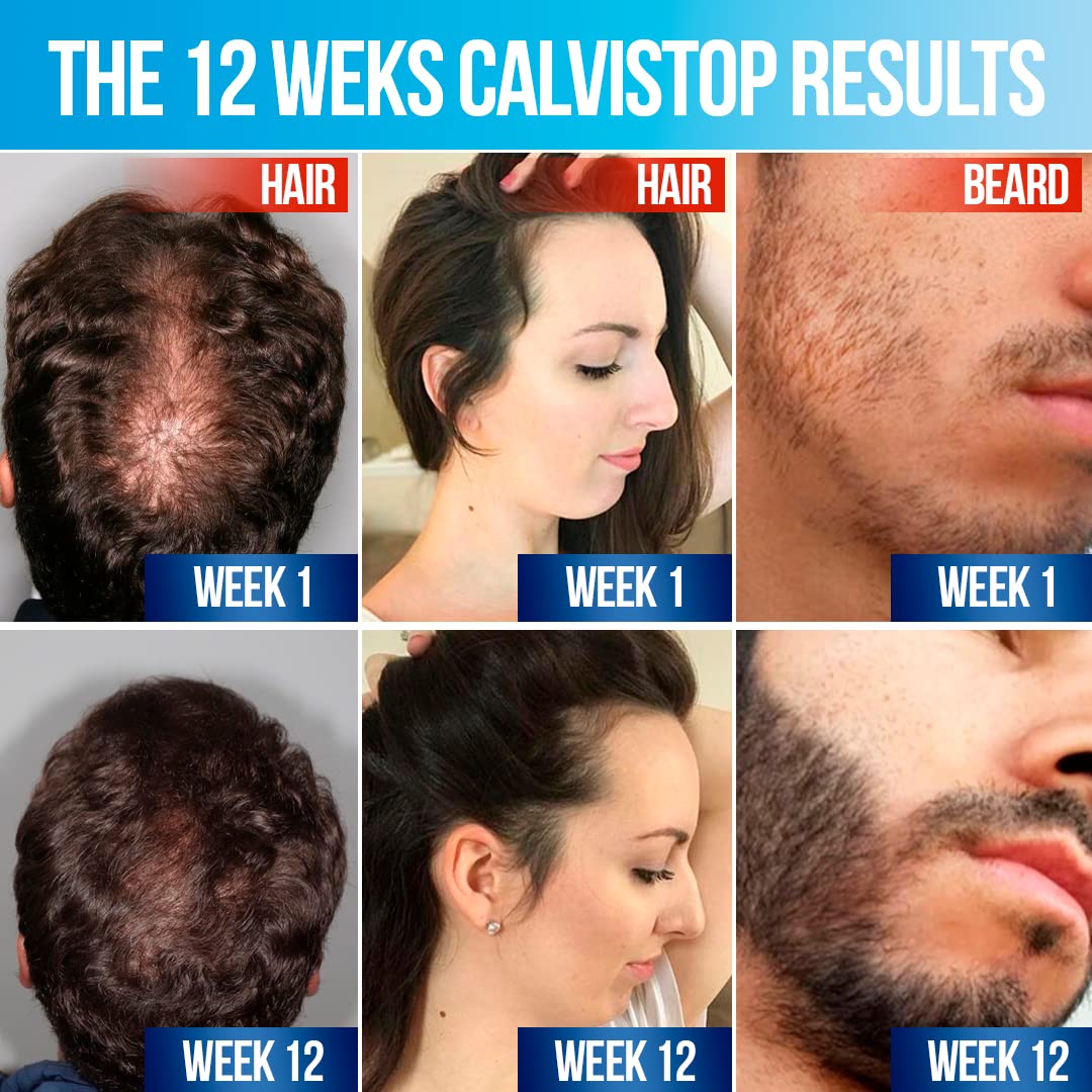 Best Hair Growth Tonic Set - 4 Bottles with Applicator for Thicker, Stronger & Healthier Hair | Natural Hair Regrowth Treatment for Men & Women | Perfect for Daily Scalp Care & Hair Loss Prevention