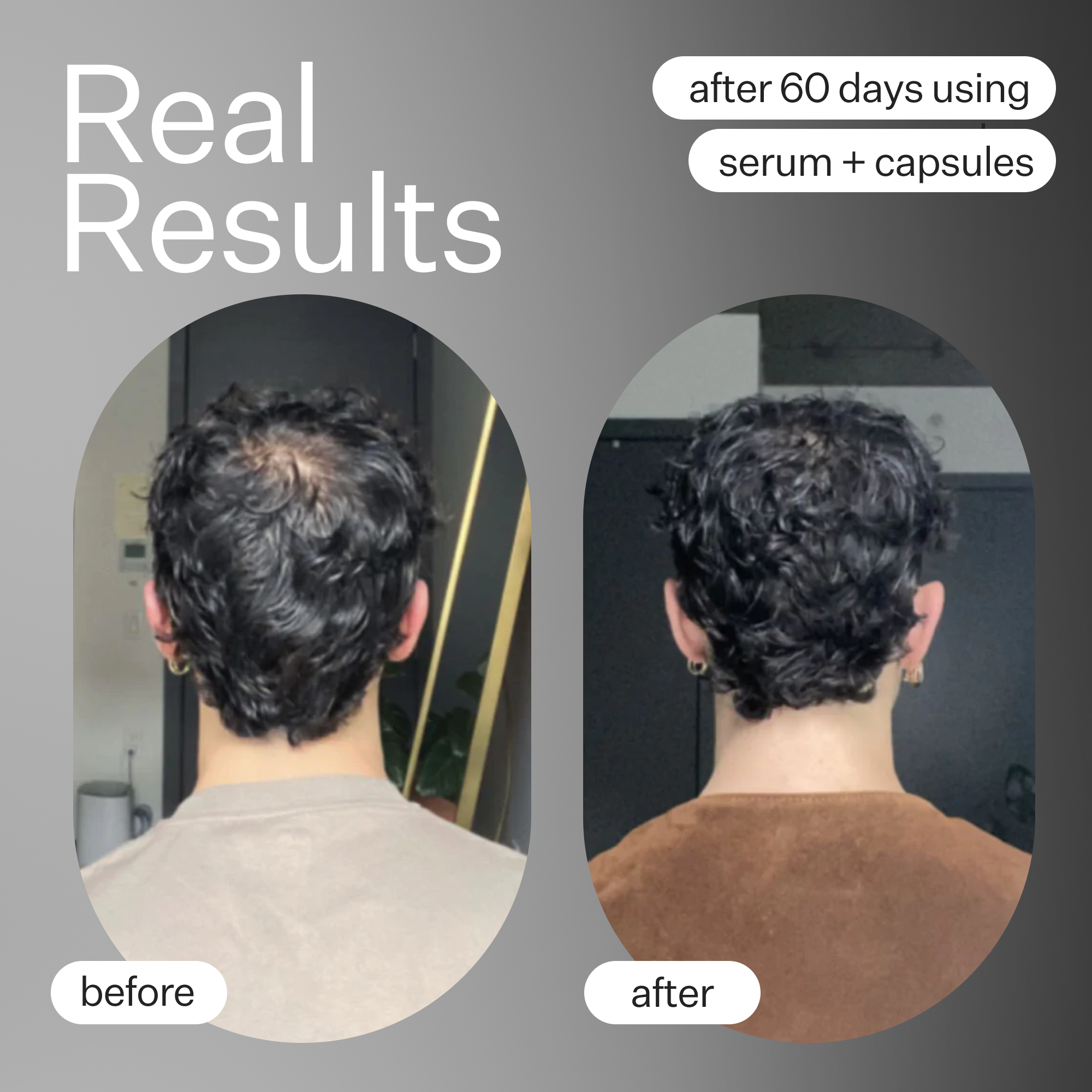 Stem Cell Scalp Serum for Hair Growth & Thinning Hair - Anti Hair Loss Treatment with Natural Ingredients - Perfect for Men & Women with Dry Scalp or Dandruff Issues