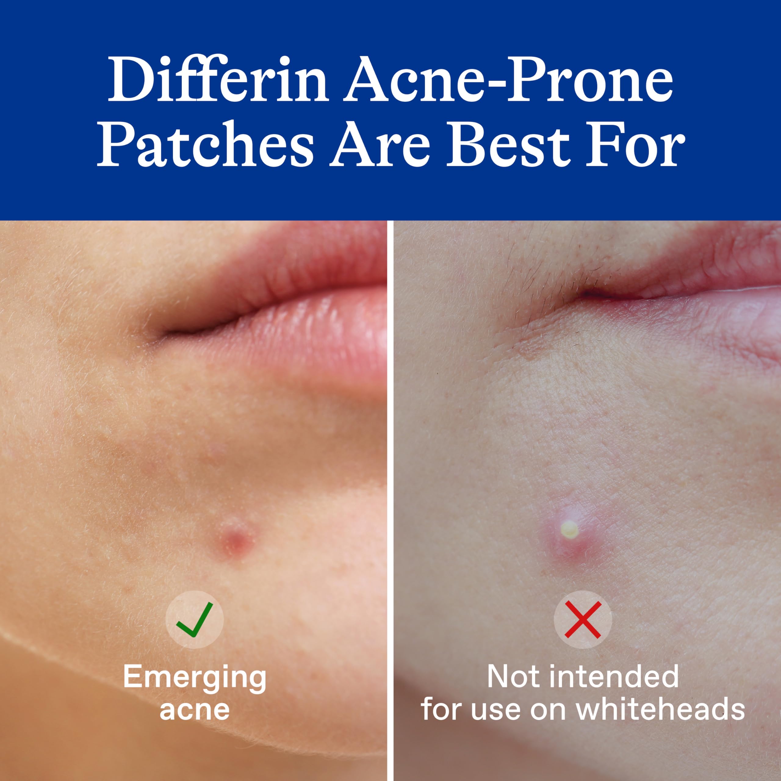 Differin Acne Patches with Salicylic Acid & Centella - 36 Count Pimple Patches for Acne Prone Skin | Fast Triple Action Treatment for Day & Night Use | Dermatologist Tested | Perfect for Travel, Gym & Daily Skincare Routine