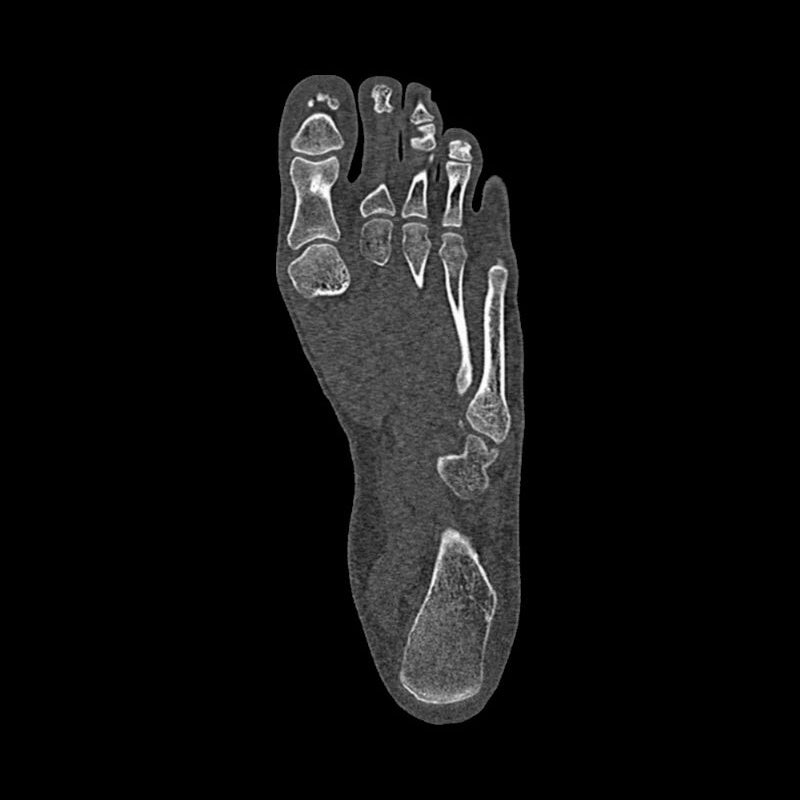 Foot Phantom Metatarsal Fractures Model - Realistic CT Scan & X-Ray Training Tool for Medical Students & Radiologists - Perfect for Anatomy Study & Diagnostic Practice