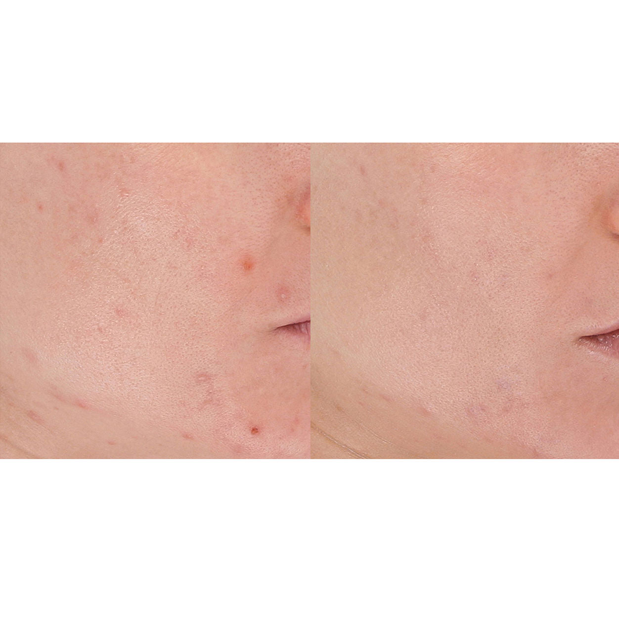 LightStim LED Light Therapy Device for Acne Treatment - FDA Cleared, Red & Blue Light Therapy for Clear Skin at Home or Salon Use