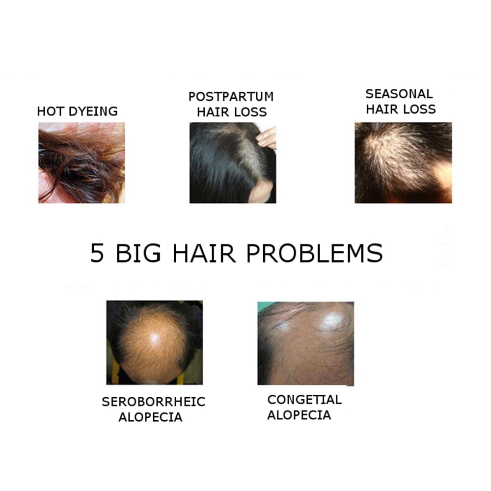 Natural Hair Growth Serum with Ginger Essential Oil - Anti Hair Loss Treatment for Healthy, Strong & Thick Hair | Stimulates Follicles, Reduces Breakage & Revitalizes Scalp | Perfect for Thinning Hair, Baldness & Brittle Hair Care at Home