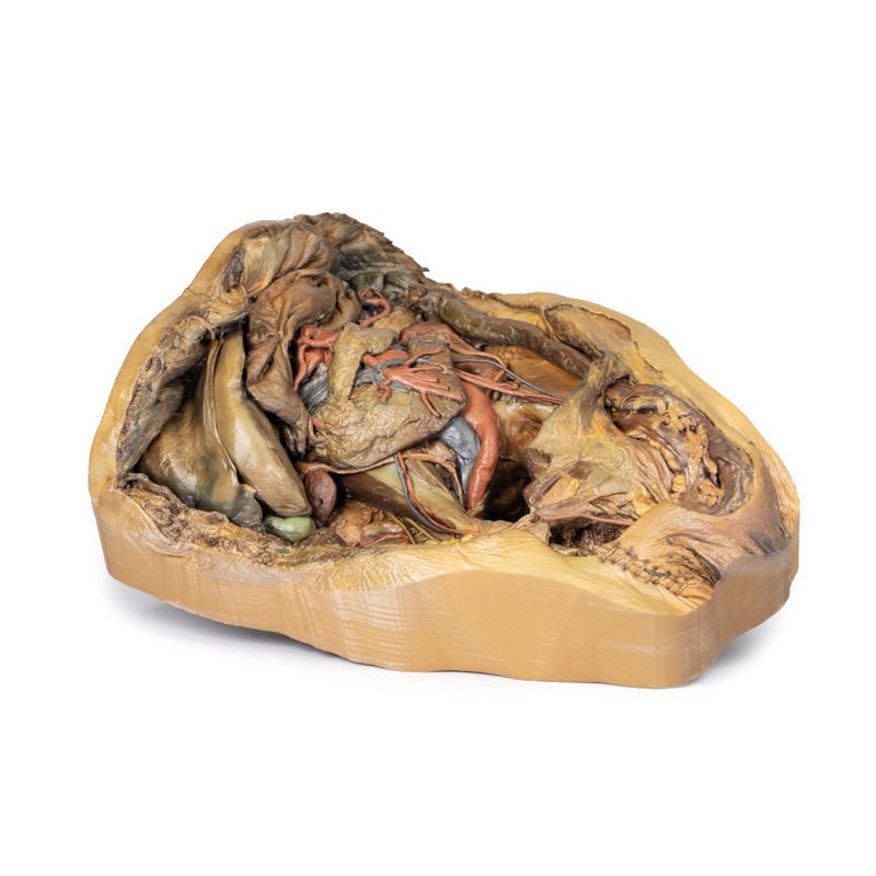 3D Printed Abdomen Model with Inguinal Hernia - Medical Training & Anatomy Study Tool for Students, Doctors & Surgeons