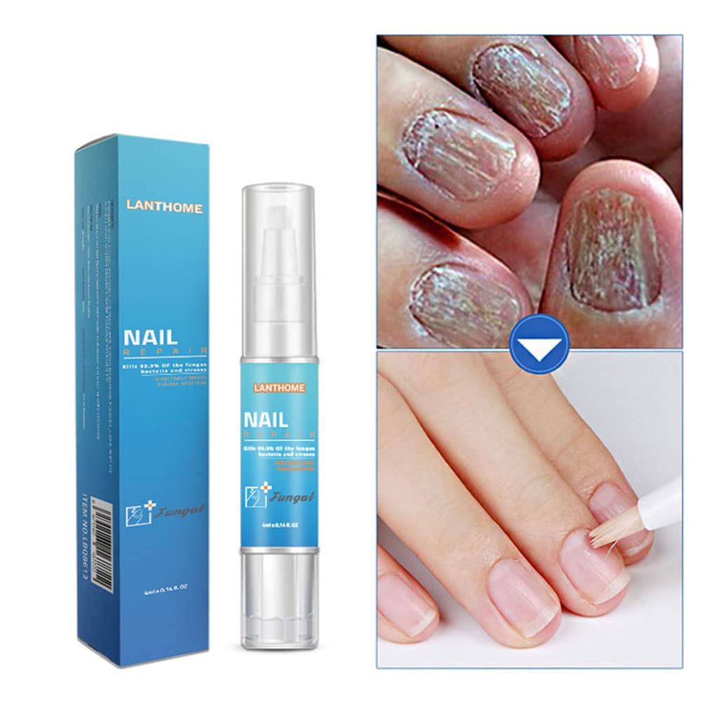 Ofanyia Anti-Fungal Nail Treatment Pen for Toenail & Fingernail Fungus Repair - Strengthens Brittle Nails & Promotes Healthy Growth - Effective Nail Care Solution for Athletes, Swimmers & Daily Use