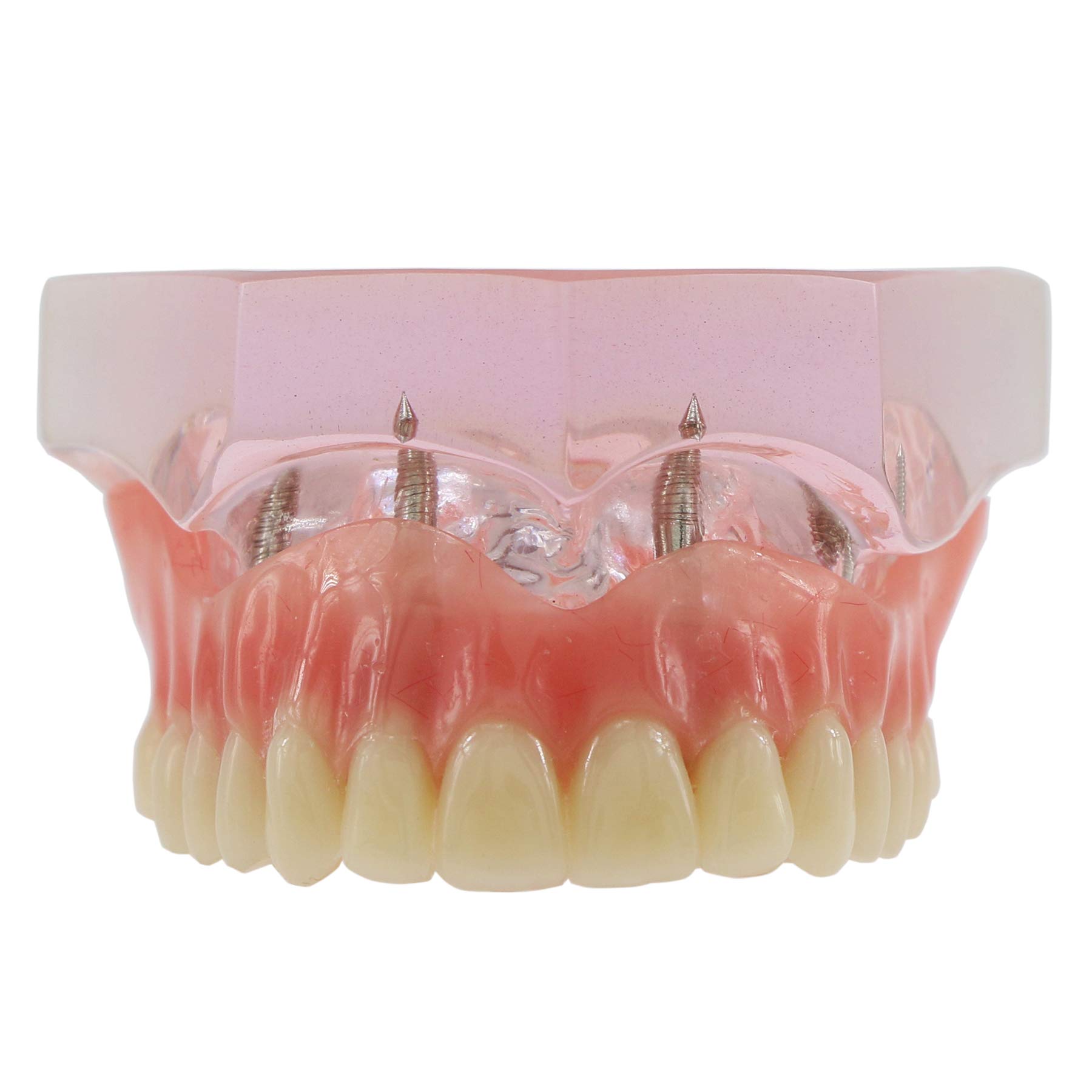 Dental Implant Typodont Model M6001 - Pink Upper Jaw Overdenture with 4 Implants for Superior Restoration | Ideal for Dental Students, Teaching & Clinical Practice