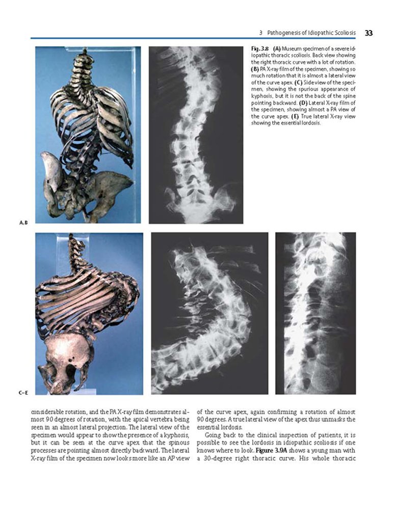 Idiopathic Scoliosis Treatment Guide - Harms Study Group Recommendations for Spinal Correction & Pain Relief | For Doctors, Physical Therapists & Patients