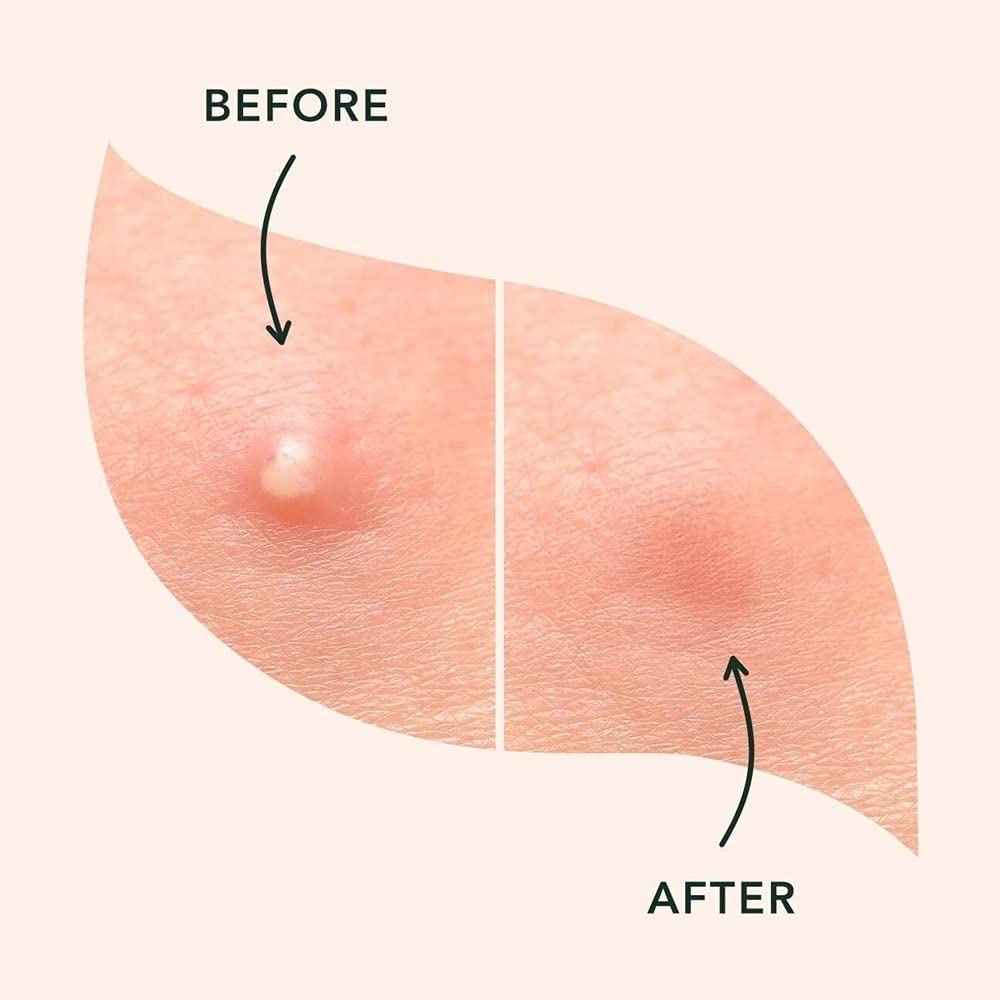 PHARMASIC Acne Care Pimple Patch (36 Count) - Hydrocolloid Spot Treatment for Face & Body, Ultra-Thin Invisible Patches for Teens & Adults - Fragrance-Free, 2 Sizes - Perfect for Day/Night Use & On-the-Go Acne Relief