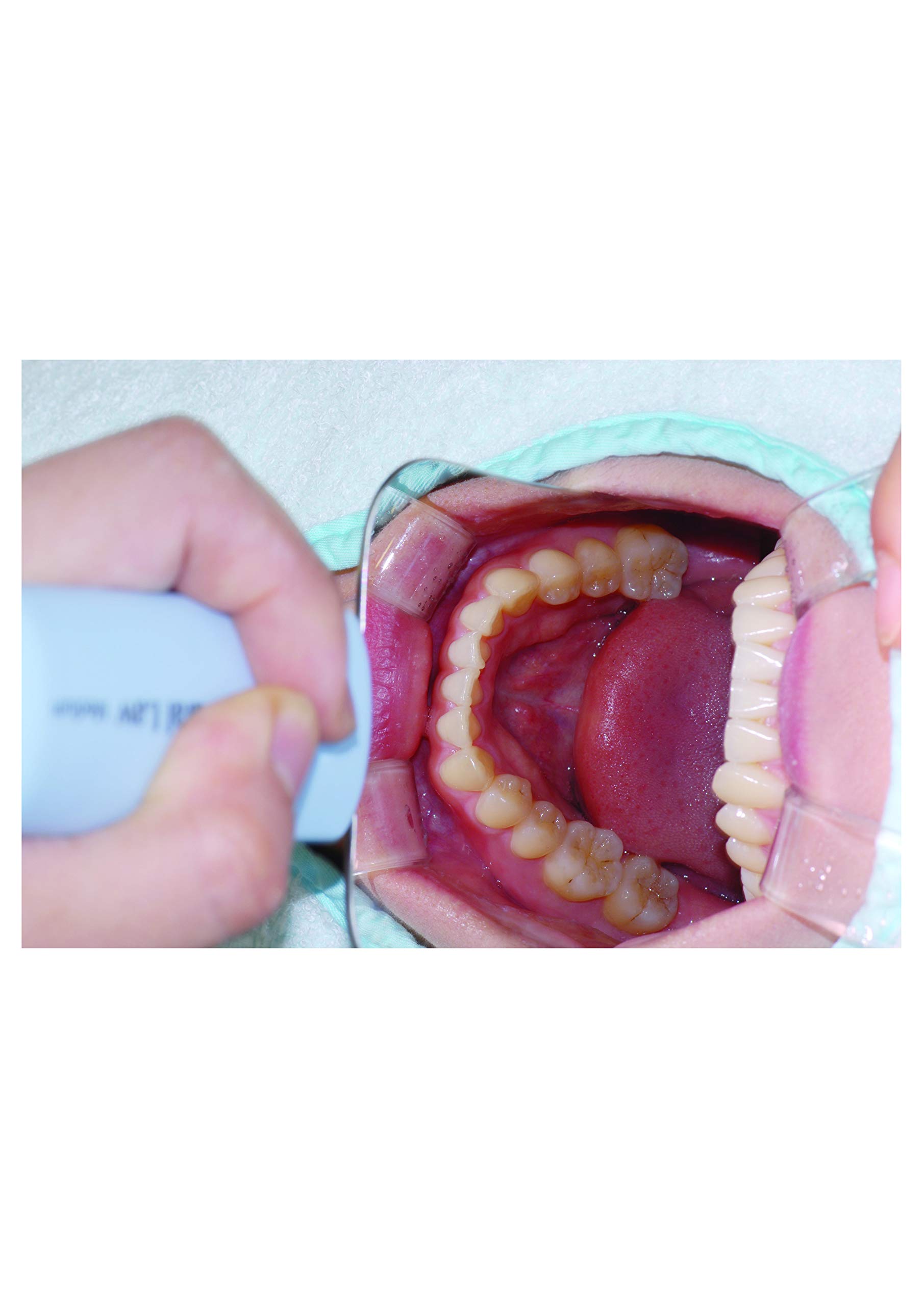 OSUNG Dental Mirror - Intraoral Photography Mirror with Handle, Large Occlusal Size for Dentists & Hygienists | Perfect for Dental Exams, Oral Hygiene Checks & Professional Photography