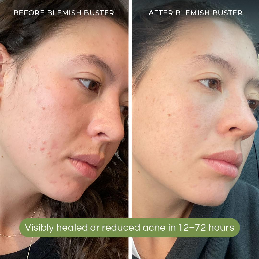 SONYA DAKAR Blemish Buster - Acne Spot Treatment with Salicylic Acid & Sulfur for Clear Skin | Camphor & Probiotics (Lactobacillus/Bifidobacterium) | Tinted Clean Beauty Formula .25 oz - Perfect for Daytime Use & On-the-Go Skincare