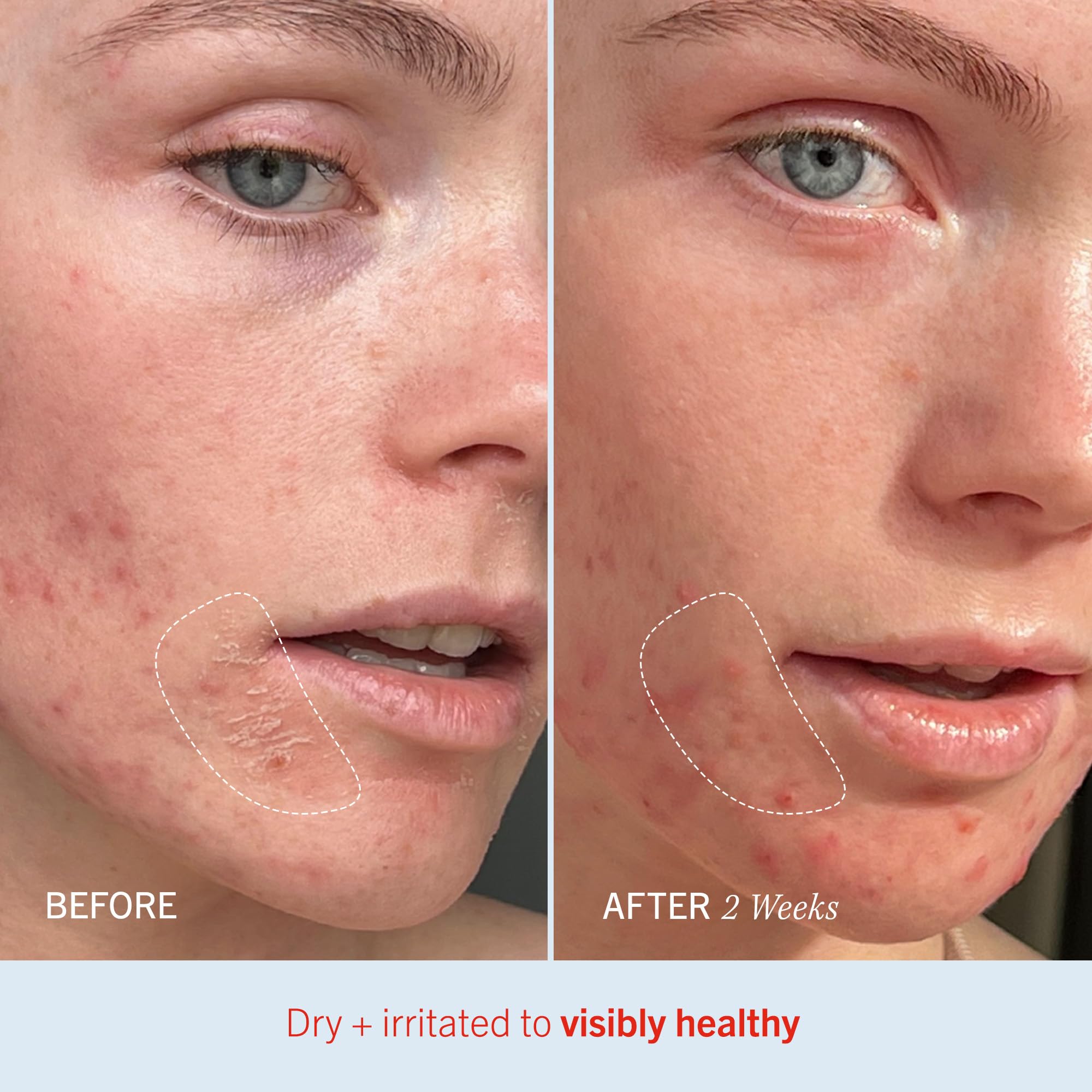 First Aid Beauty Ultra Repair Cream - Intense Hydration Colloidal Oatmeal Moisturizer for Face & Body | Clinically Proven to Strengthen Skin Barrier in 7 Days | Eczema Relief | 6 oz | Perfect for Dry, Sensitive Skin & Winter Care Routine