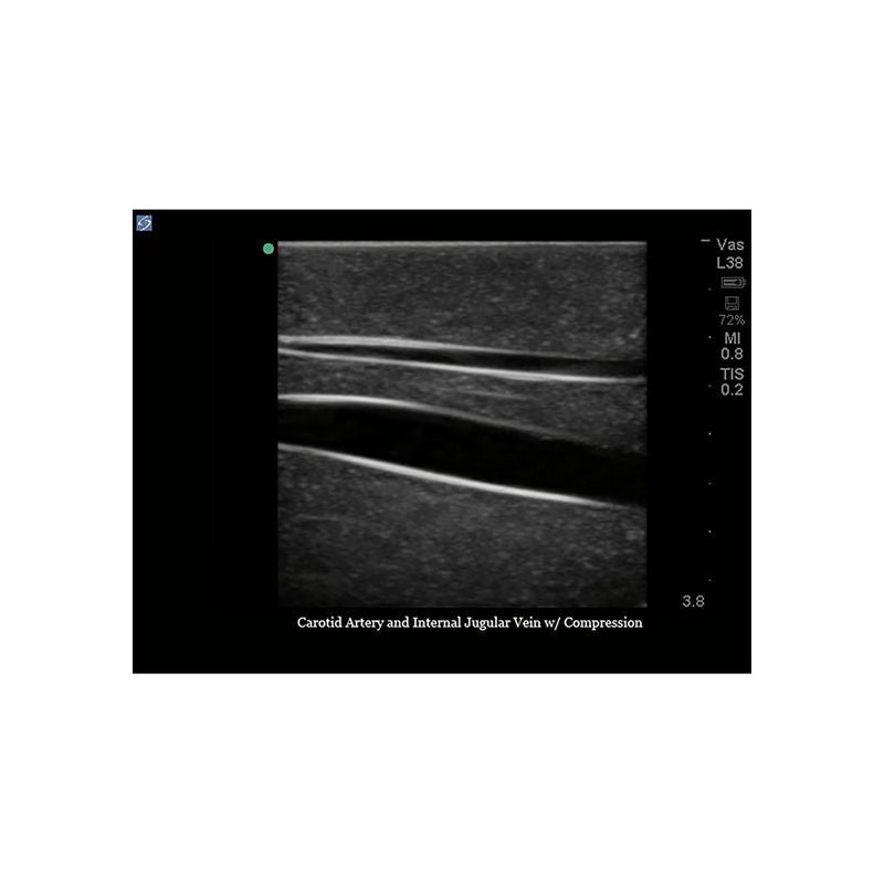 Gen II Central Line and Regional Anesthesia Replacement Insert - Sterile Medical Catheter for IV Therapy & Pain Management in Hospitals & Clinics