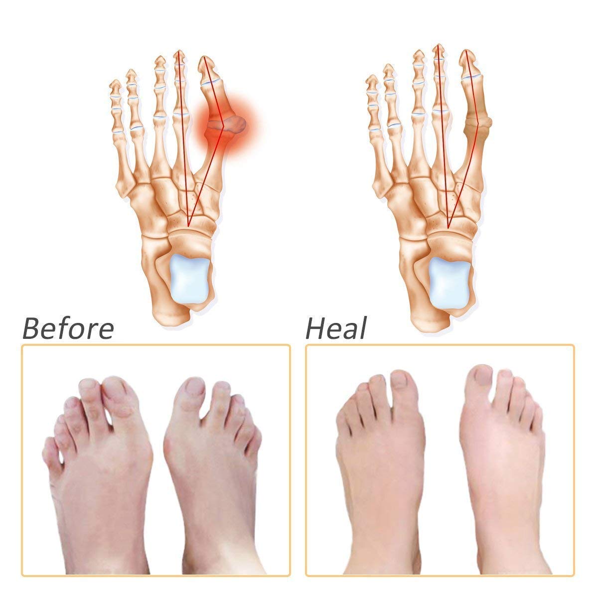 Vietnam Silicone Gel Half Toe Sleeve - Anti-Skid Forefoot Soft Pads for Pain Relief & Heel Protection - Repair Dry Cracked Skin - Ideal for Running, Hiking & Everyday Comfort