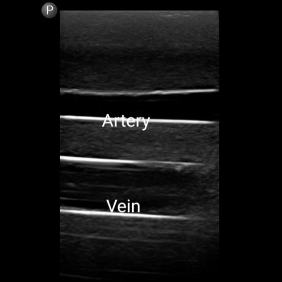 Gen II Femoral Vascular Access & Regional Anesthesia Ultrasound Training Model - Medical Simulation for Ultrasound-Guided Procedures Practice