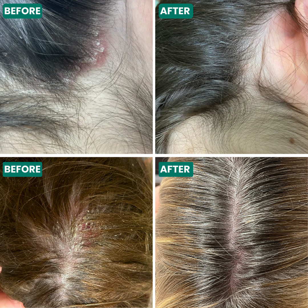 Natural Scalp Relief Oil for Dry Itchy Scalp - Soothes Irritation & Promotes Hair Growth - Perfect for Daily Scalp Care & Massage